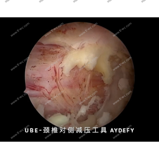颈椎Floodwood对侧减压工具要求:细弯细杆跨中线，弧度适配颈椎，微创安全完成对侧减压