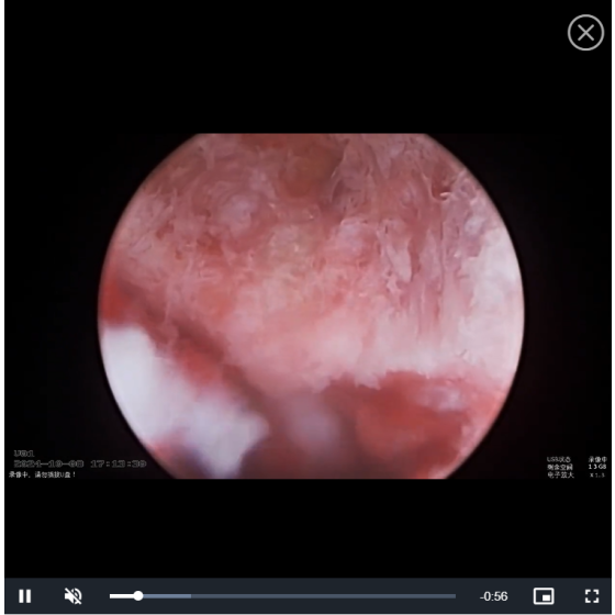 Transverse adjustment of the UBE surgical instrument - fusion device